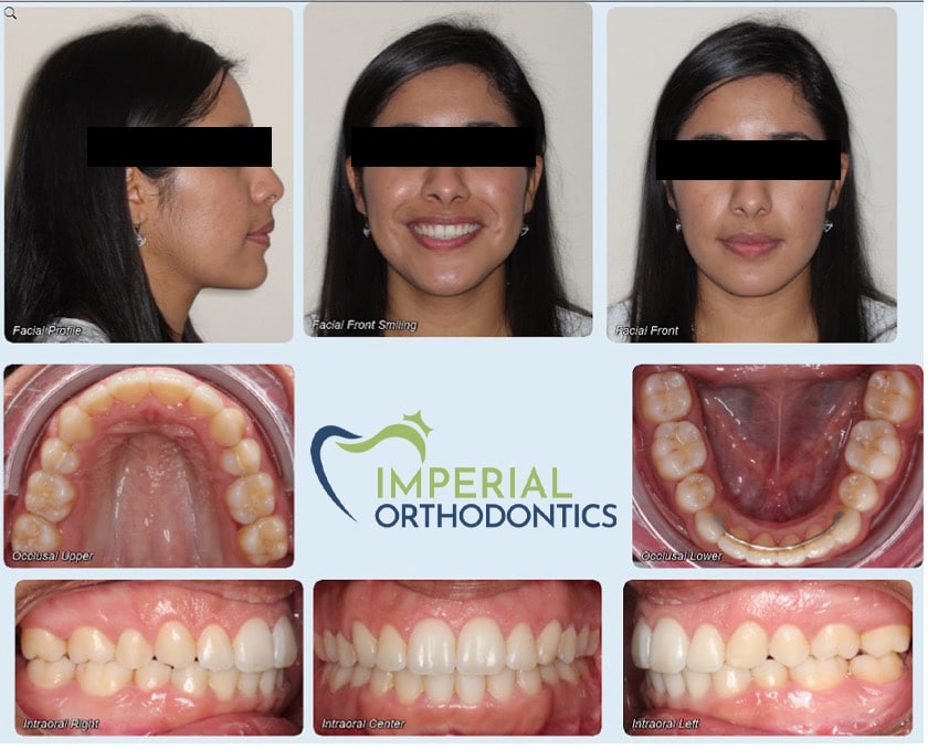 Surgical case Imperial Orthodontics in Sugar Land, TX