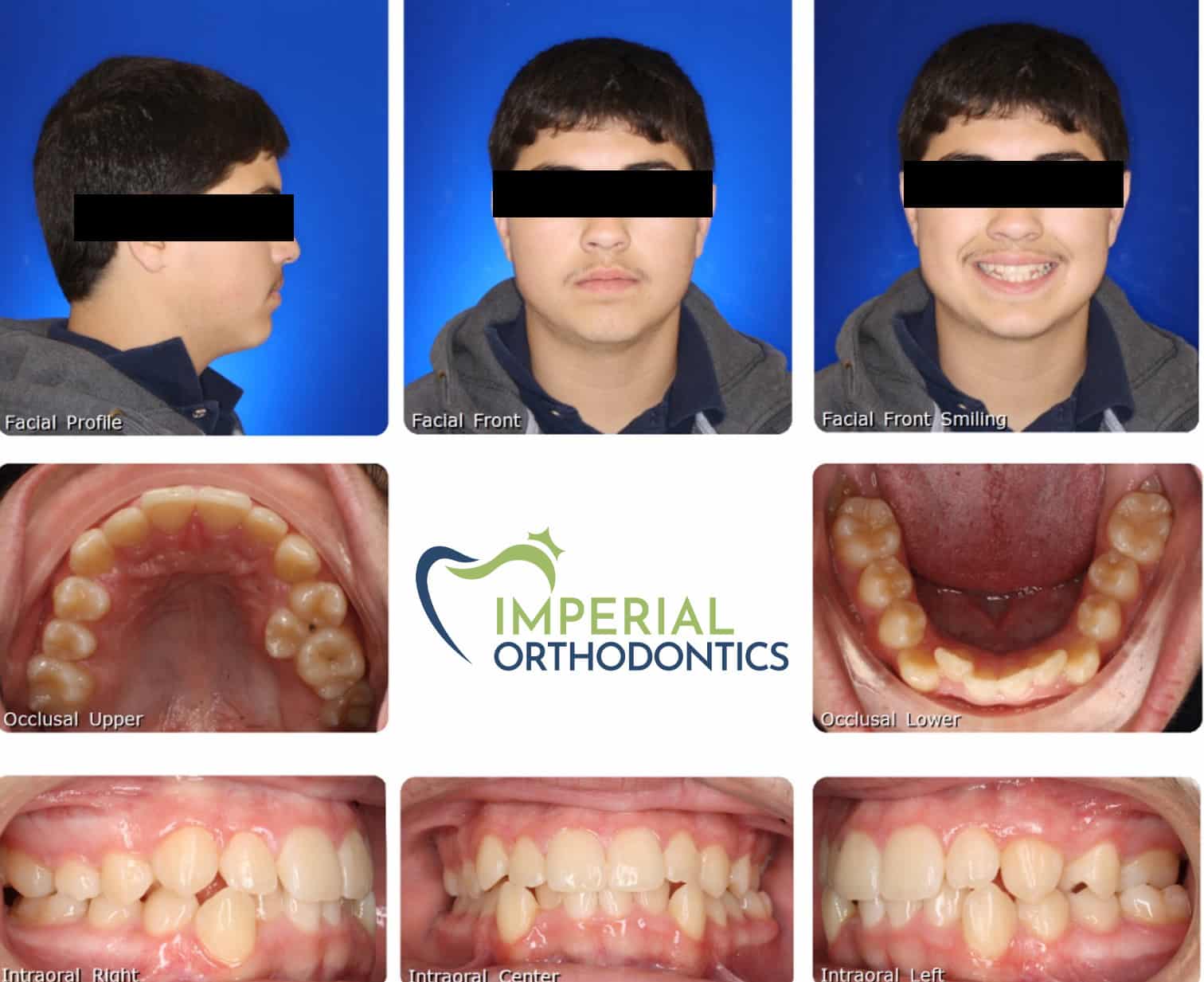 Before and after Imperial Orthodontics in Sugar Land, TX