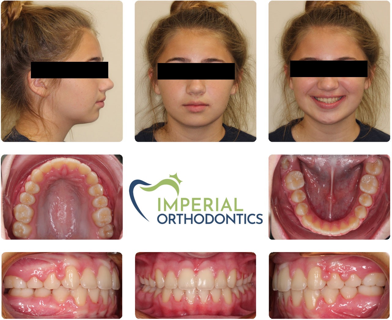 Before and after Imperial Orthodontics in Sugar Land, TX